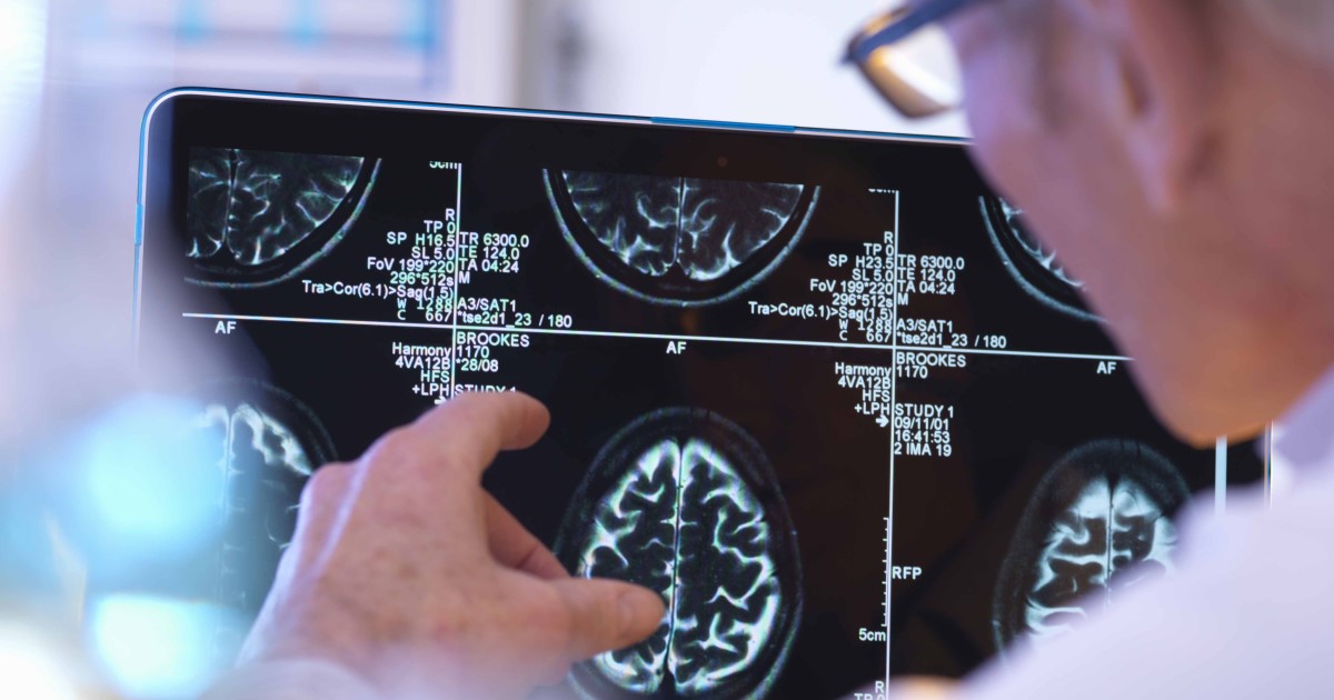 Image of a brain examined by a medical professional