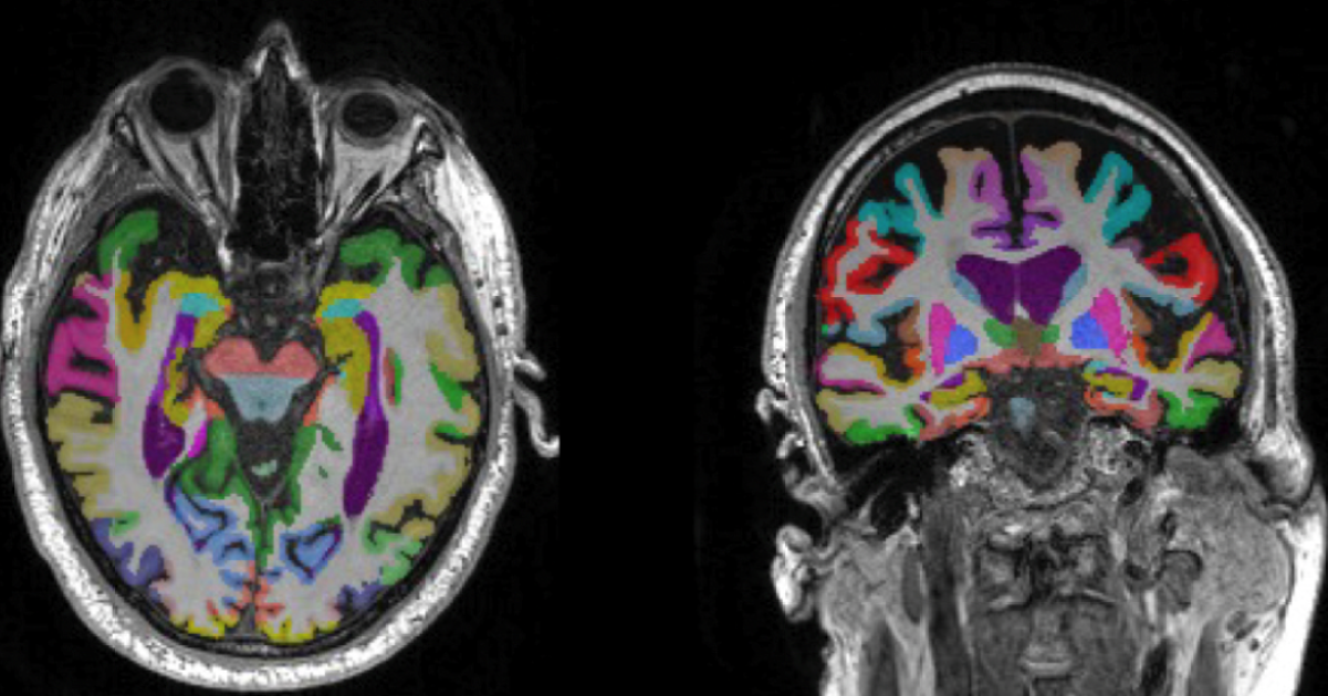 MRI scans dementia AI