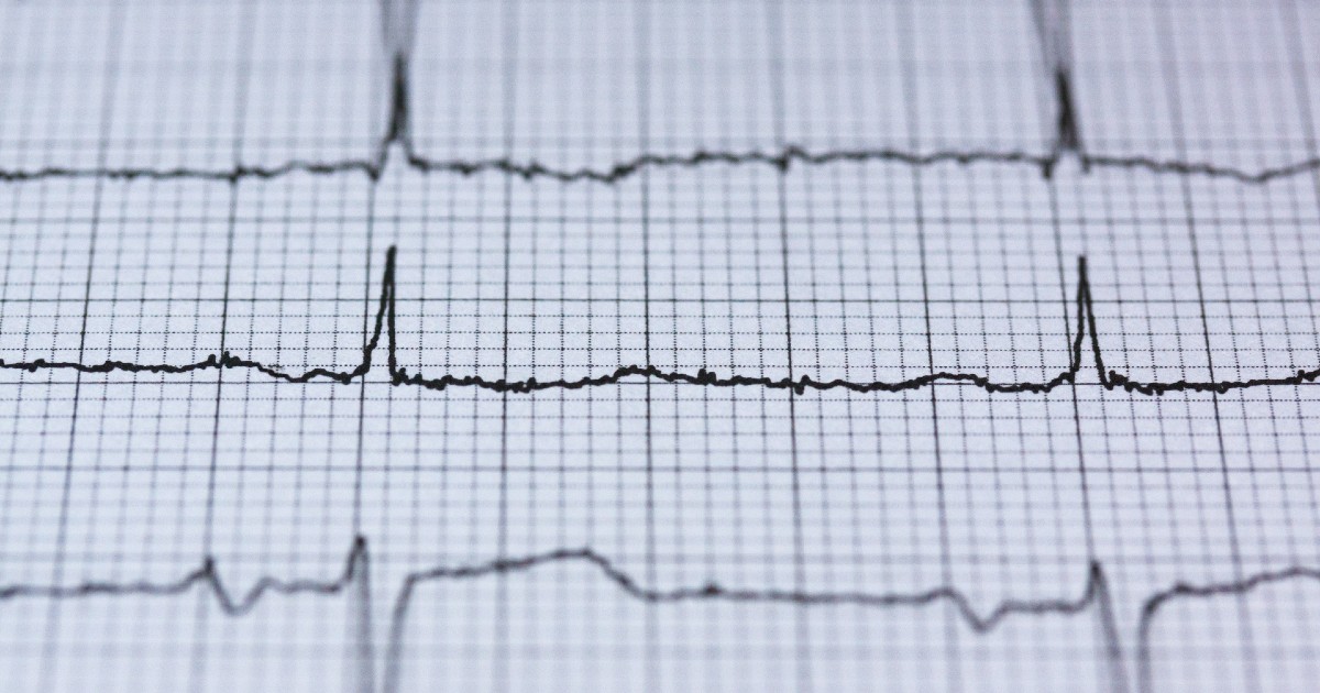 An EKG readout