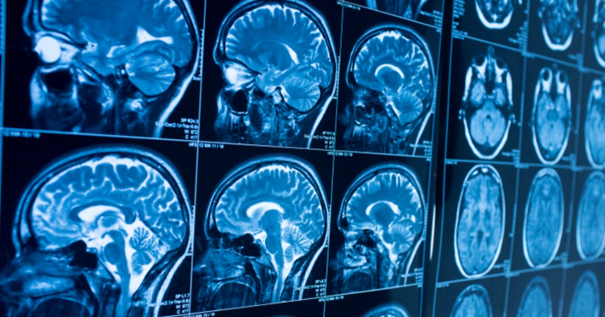 A stock image of brain scans