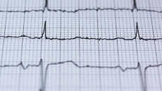 An EKG readout