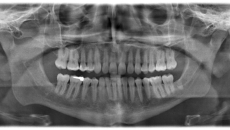 Dental X-rays