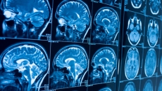 A stock image of brain scans