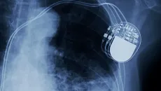 Cardiac implant shows on a medical image