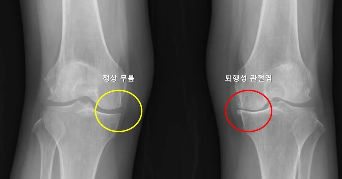 A knee X-ray image showing the difference between healthy and arthritic knees A knee X-ray image showing the difference between healthy and arthritic knees