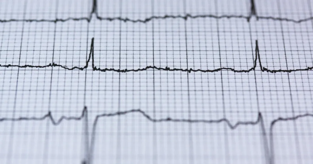 An EKG readout