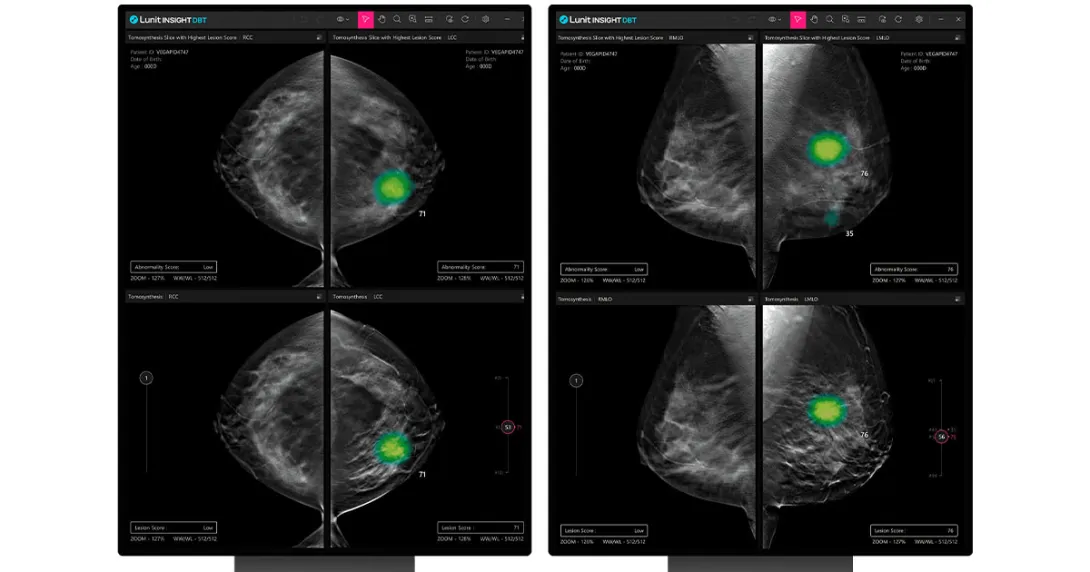 Mammography images side-by-side with and without AI to detect breast cancer Mammography images side-by-side with and without AI to detect breast cancer