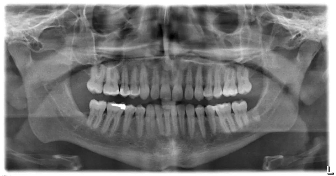 Dental X-rays
