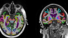 MRI scans dementia AI